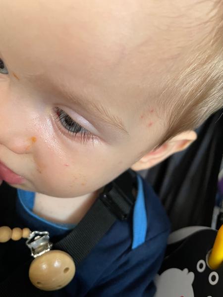 Co dělat při objevení krve v oku u dítěte?