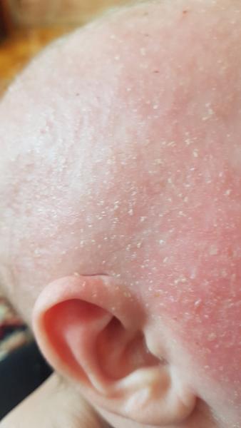 Ekzém / Seborea. Co by to mohlo být?