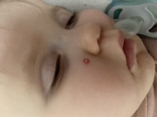 Hemangiom u roční dcery. Máte zkušenost s případnou léčbou?