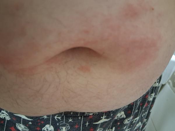 Vyrážka u dospívajícího syna. Může to být svrab?