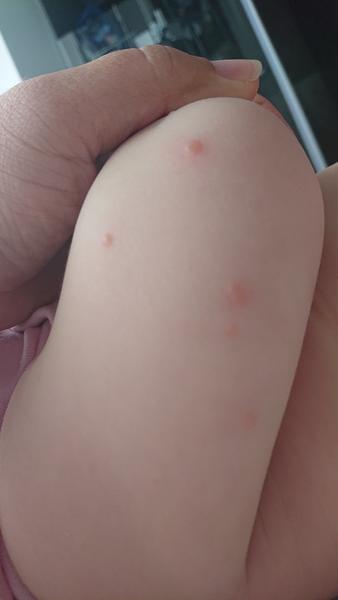 Pupínky na obličeji u miminka: Komáří štípnutí nebo alergie?