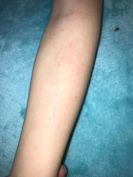 Co znamenají škrábance jako vyrážka na rukou?