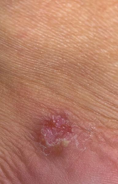 Bílý svědivy pupinek