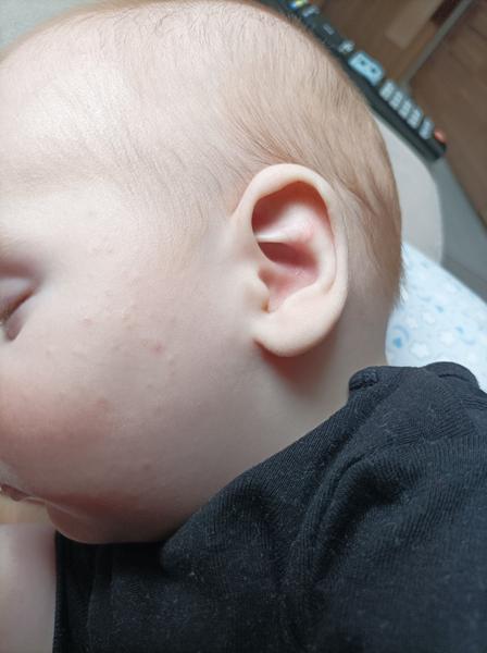 Ekzém, nebo něco jiného?