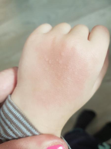 Co způsobuje pupínky u dětí a jak je léčit?