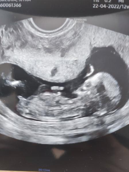 Tipování pohlaví miminka: Kluk nebo holčička?