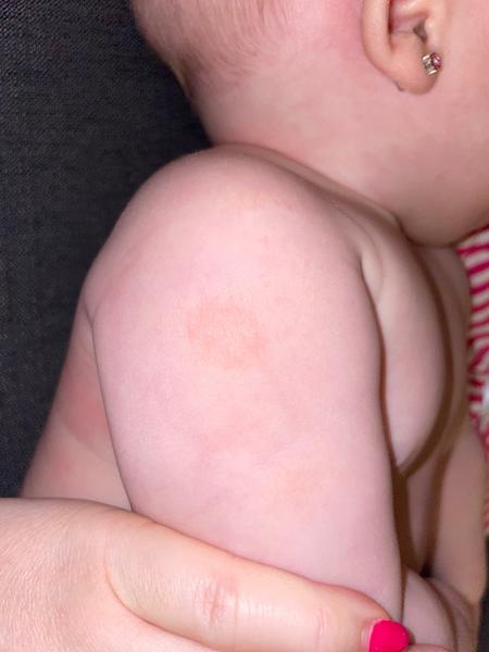 Může být vyrážka na rukou a zádech atopický ekzém?