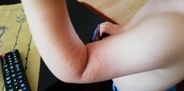 Nevíte prosím někdo, co je to za vyrážku?