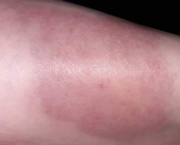 Dítě něco píchlo. Jít k lékaři?