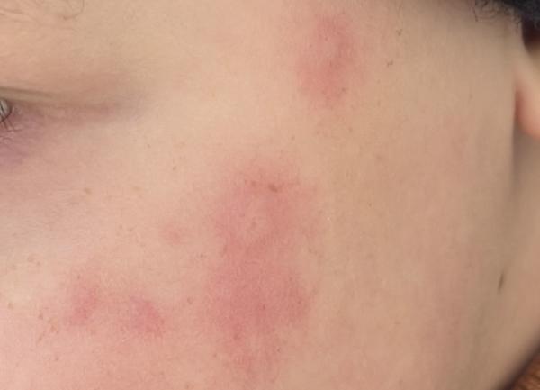 Co znamenají fleky na tváři bez dalších příznaků?