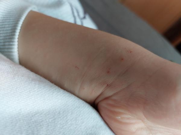 Kožní problémy po prodělané nemoci. Jak na svědění u dětí?