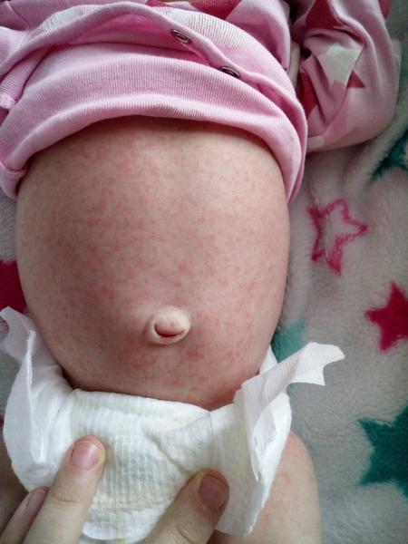 Vyrážka, co by to mohlo být?