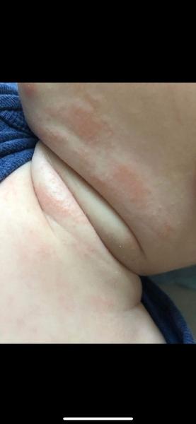 Co způsobuje ekzém u plně kojeného miminka?