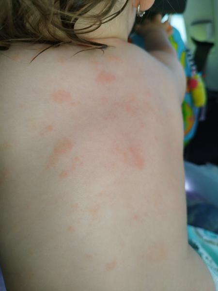 Vyrážka, oranžové flíčky, 1 rok. Může to být množštvím bílkovin?