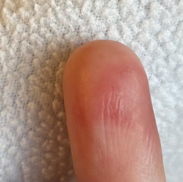 Vodnaté pupínky a zarudlý flek na prstu: Příčiny?