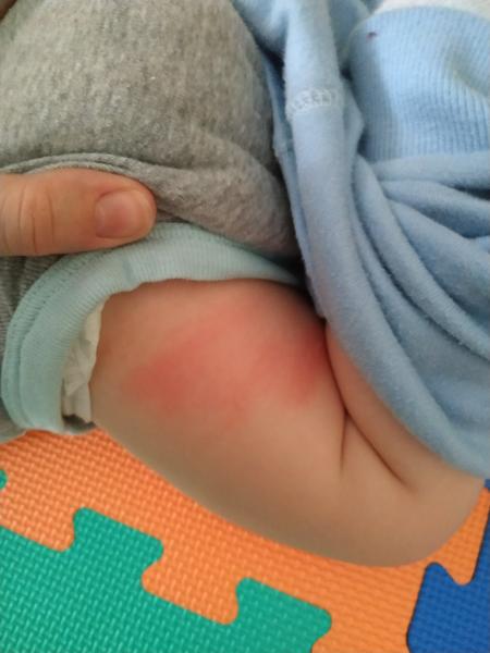 Vyrážka u 9měsíčního chlapečka. Nevíte, co to může být?