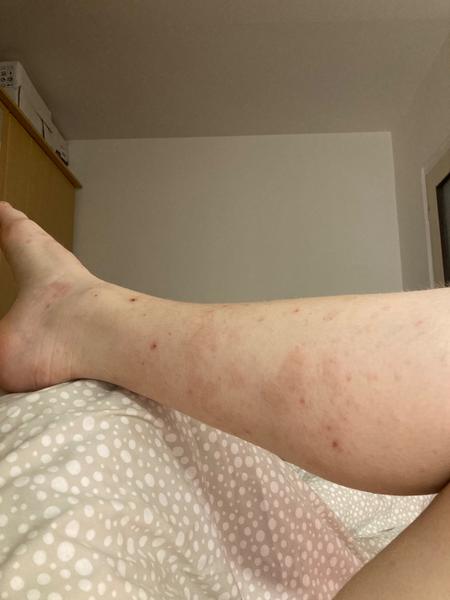 Vyrážka a skvrny na nohou. Co by to mohlo být?