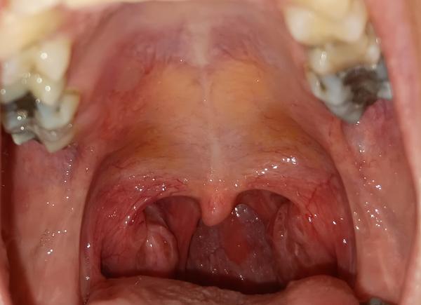 Útvar na patře a bolest krku. Co to může být?