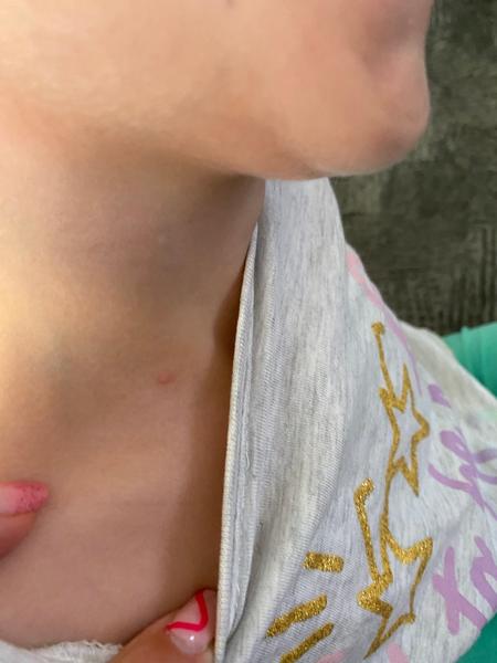 Červené fleky na kůži dítěte. Co to může být?