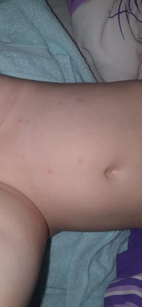 Vyrážka, infekce nebo neštovice. Poradíte, prosím, co by to mohlo být?