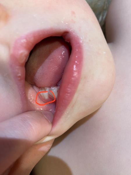 Bílý flíček na zubu u dvouleté dcery. Co dělat?