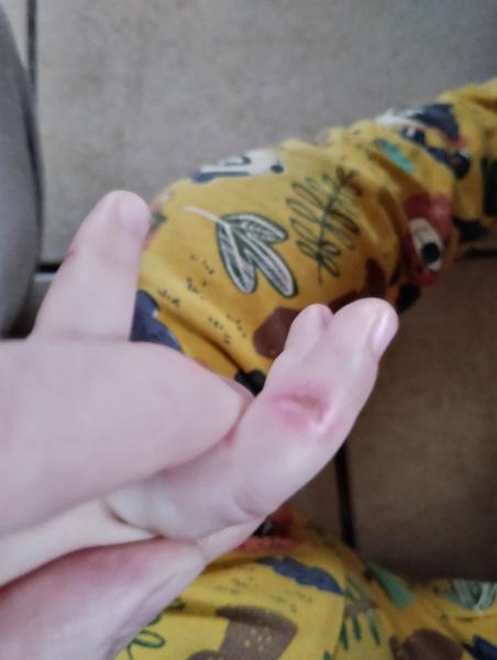 Poraněný prst. Je to na návštěvu lékaře?