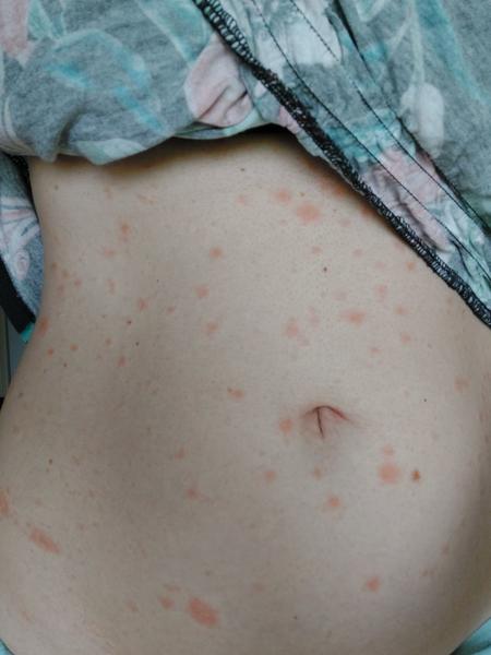 Je to pityriasis rosea? Zkušenosti a léčba této vyrážky.