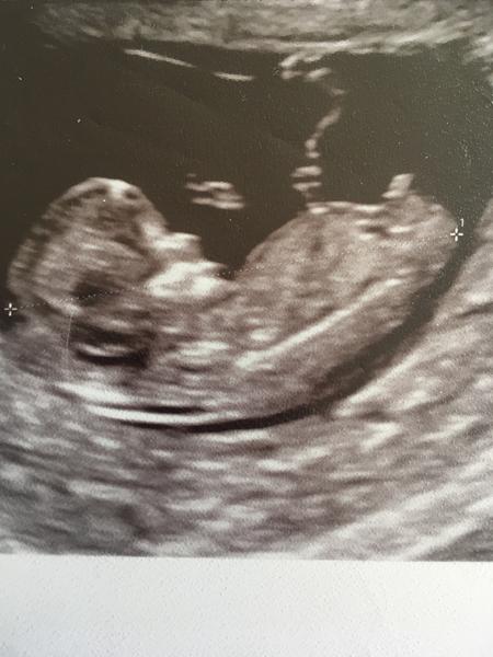 Je vidět uzel na pupečníku?