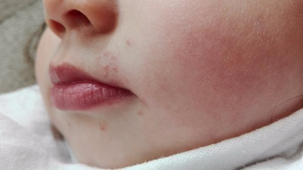 Vyrážka se rozlézá kolem celé pusinky, co to je?