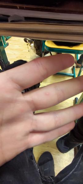 Bolestivé pupínky na ruce. Jaká je možná příčina?