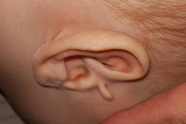 Odstranění kožního výrůstku u ucha, máte zkušenost?