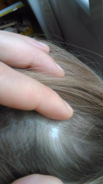 Holé místo ve vlasech u 7leté dcery