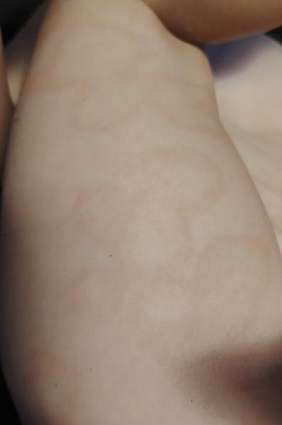 Vyrážka u syna. Za jak dlouho zmizí a kdy by mohl jít do kolektivu?