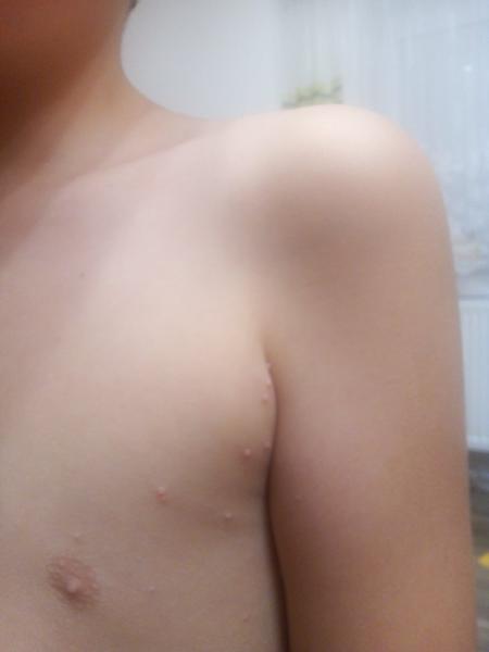 Co může způsobit nateklé puchýřky na těle dítěte?