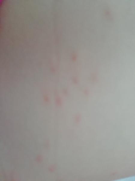 Jsou tohle neštovice?