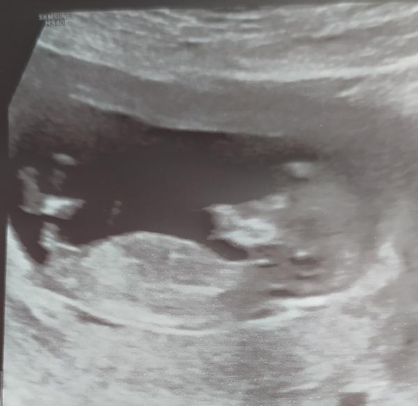 Chlapeček nebo holčička?