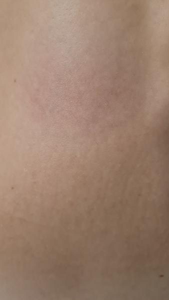 Sklerodermie u dcery. Může to být?