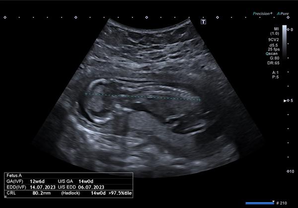 Tipování pohlaví miminka. Podělte se o své odhady!