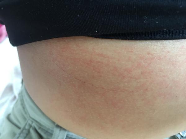 Nevysvětlitelné svědění a skvrny na pokožce: Poradíte?