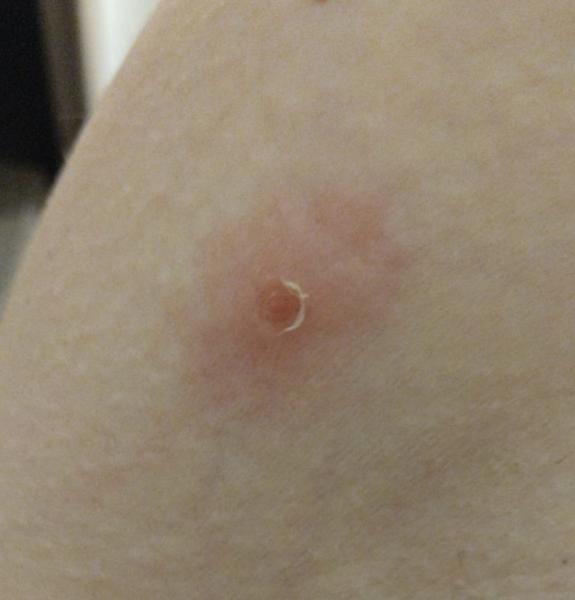 Červeně ohraničené pupínky a bolest v krku. Co to znamená?