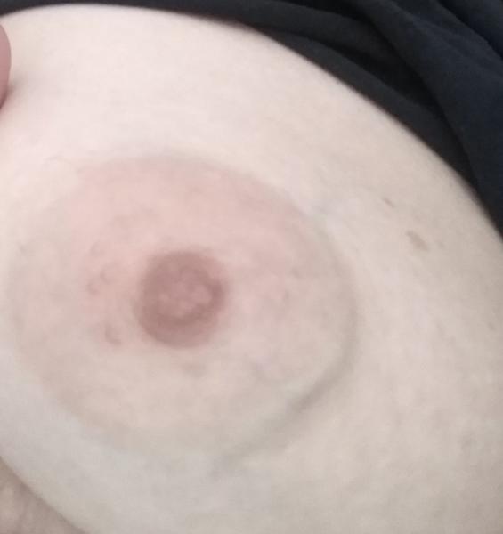 Fialová žíla na prsu. Je to něco neobvyklého?