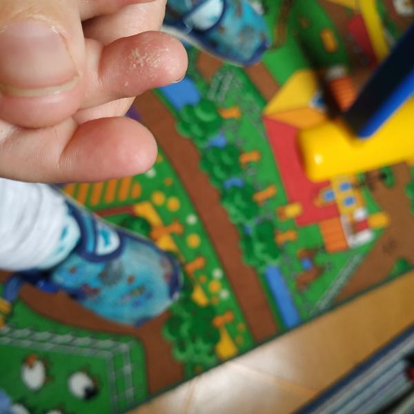 "Suché" konečky prstů s puchýřky, u dvouletého syna