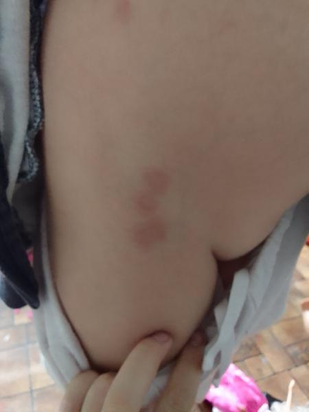 Zkušenosti s flíčky u dětí. Je to infekce?