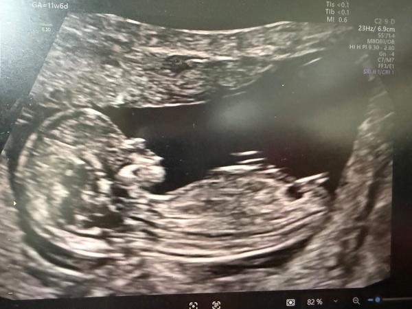 Pohlaví podle screeningu ve 12. týdnu. Co myslíte?