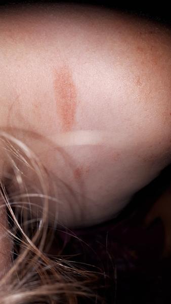 Ekzém (kvasinka) nebo alergie?