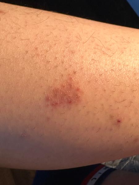 Jak rozpoznat svědivé skvrny na těle?