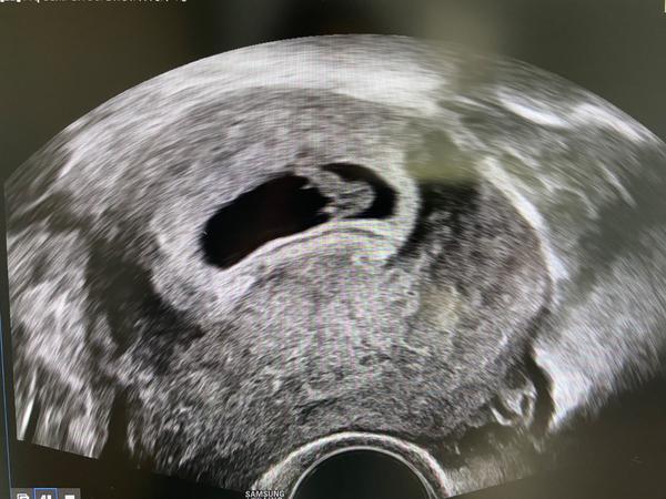 Zobák na ultrazvuku. Co to znamená?