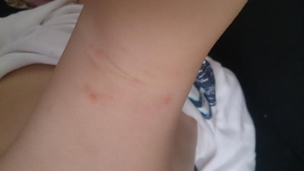 Mohou to být neštovice?