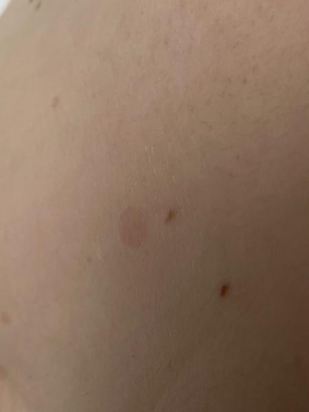 Skvrna mezi prsy. Co by to mohlo být?