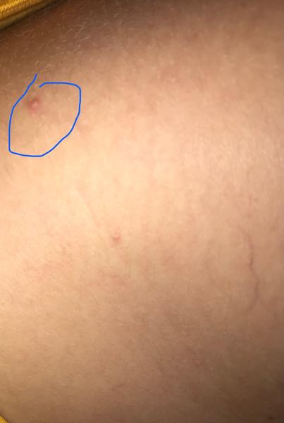 Pupínek na rameni: Co to může být?